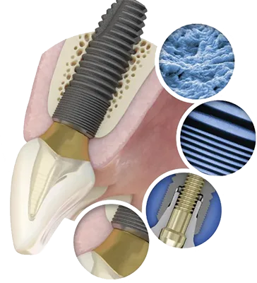 Дентальный имплантат Astra Tech Evolution